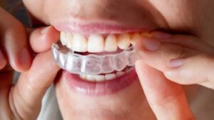 invisalign Agoura Hills
